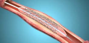 ASTM F2606 Three-Point Bending Balloon Expandable Vascular Stents and Stent Systems